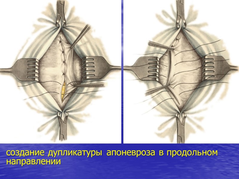 создание дупликатуры апоневроза в продольном направлении